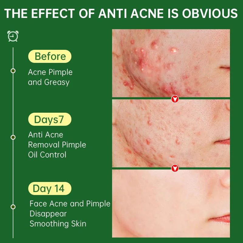 Acne Treatment Cream - Natural Herbal Formula