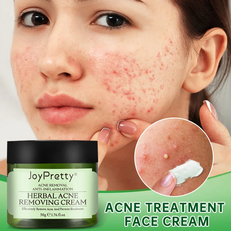 Acne Treatment Cream - Natural Herbal Formula