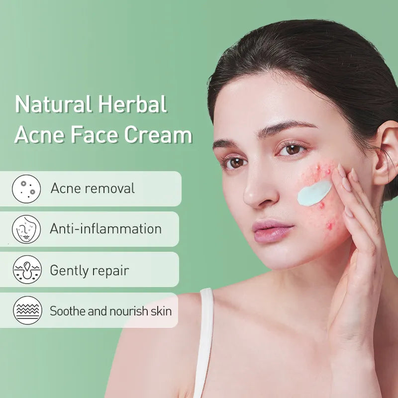 Acne Treatment Cream - Natural Herbal Formula