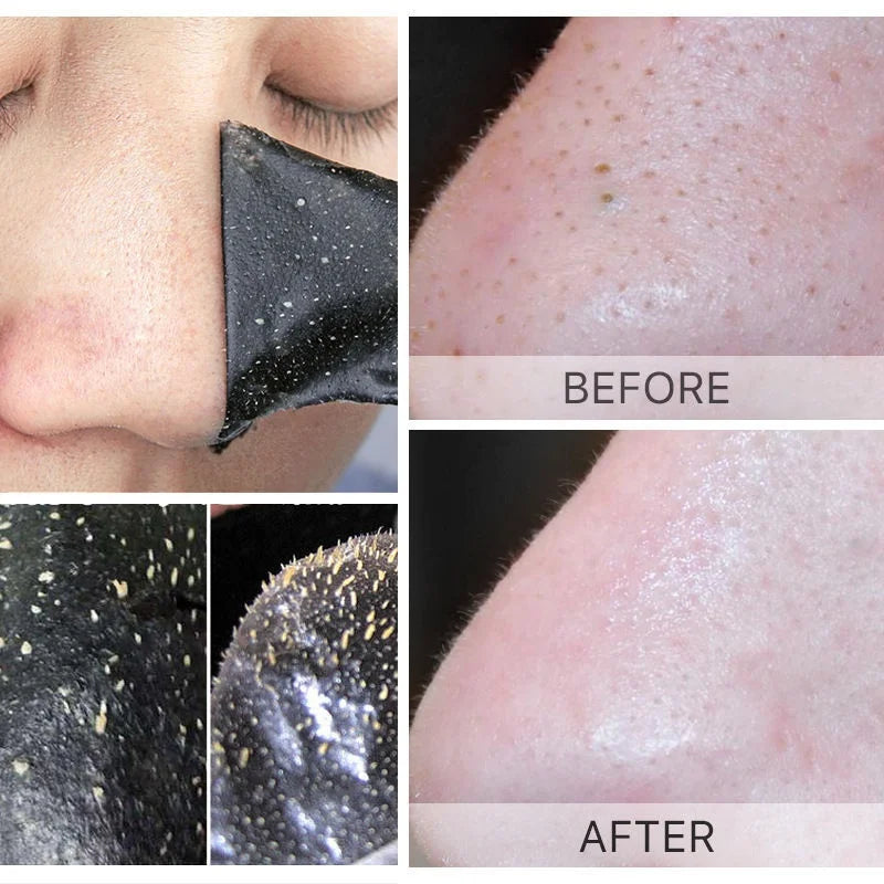 Blackhead Peel Strips