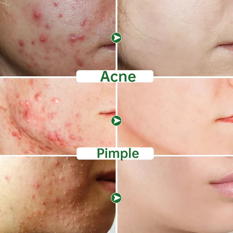 Acne Treatment Cream - Natural Herbal Formula