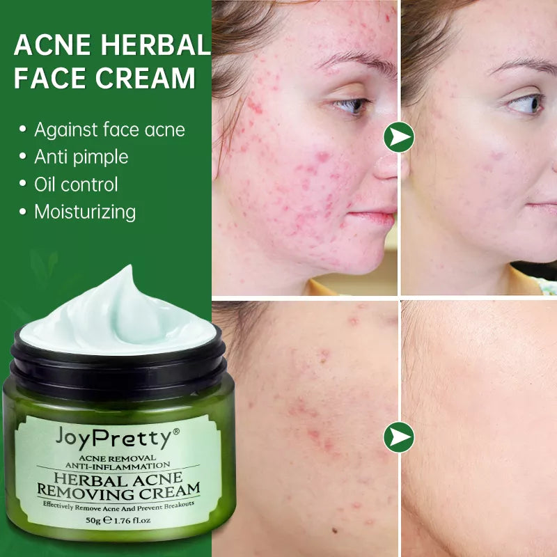 Acne Treatment Cream - Natural Herbal Formula